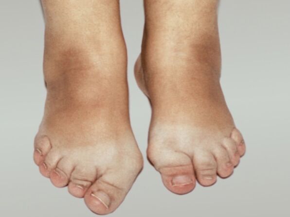 Artrose van de voet met ernstige vervorming van de tenen