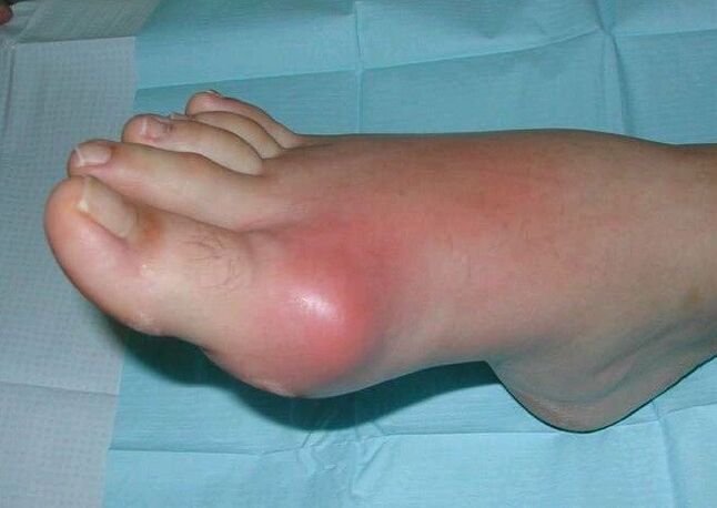 Klinisch beeld van voetartritis - zwelling en ontsteking