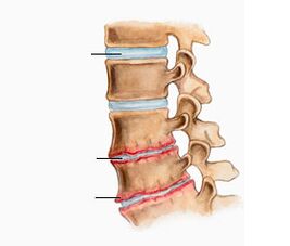 Osteochondrose