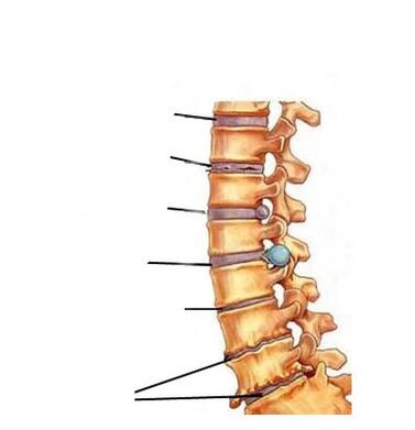 ontwikkelingsstadia van osteochondrose