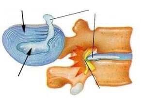 vernietiging van de vezelige ring bij cervicale osteochondrose
