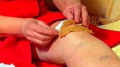 Compress voor artrose van het kniegewricht
