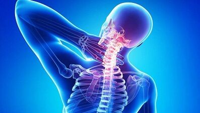 Hoe manifesteert osteochondrose zich