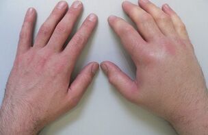 artralgie als oorzaak van pijn in de gewrichten van de vingers
