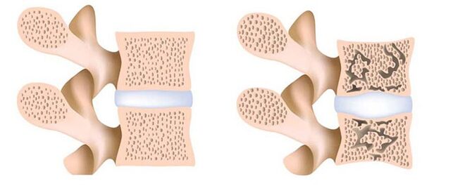osteoporose - de verwijdering van calcium uit de botten