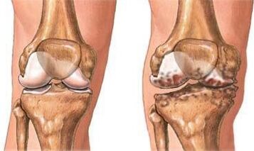 Arthrose van de knie