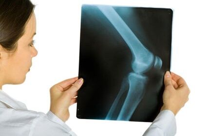 Behandeling van artrose van het kniegewricht