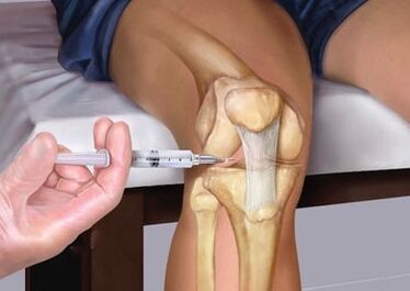 Injectie in het gewricht