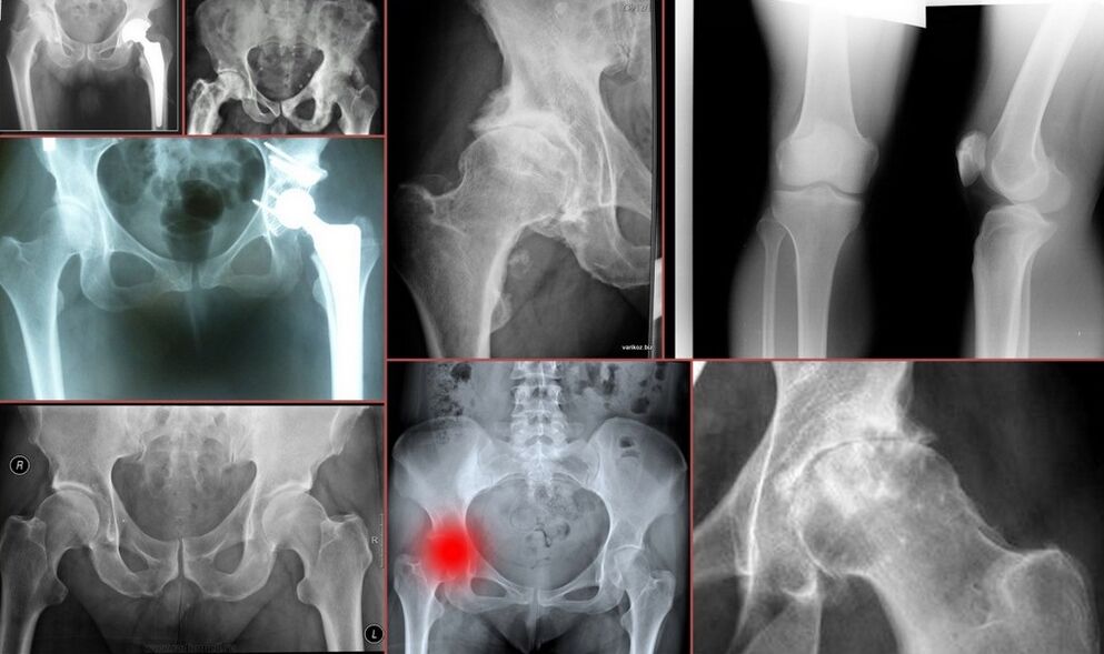 Röntgenfoto voor heuppijn