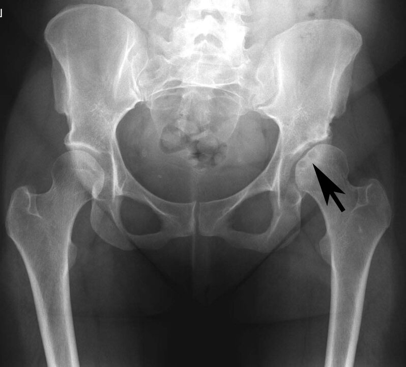 Afzetting van calciumzouten in het heupgewricht met pseudojicht op röntgenfoto's