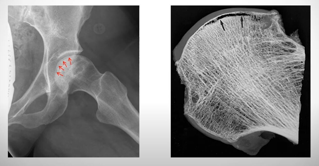 Röntgenfoto van de femurkop aangetast door aseptische necrose