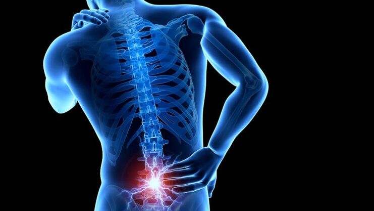 rugpijn met lumbale osteochondrose