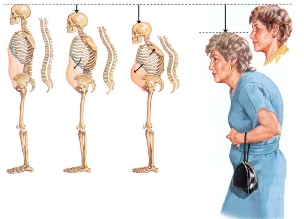 hoe werkt osteochondrosis